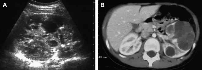Паренхиматозная киста почки на УЗИ