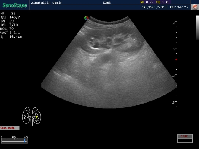 Киста у женщины в почке, снимок УЗИ