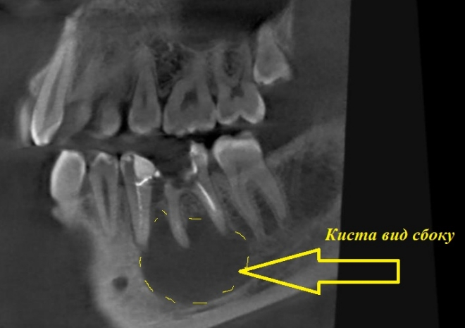 Киста зуба на рентгене