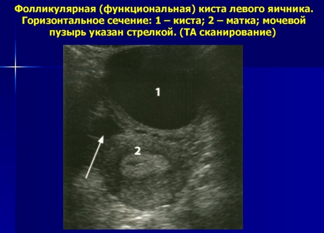 функциональная киста яичника