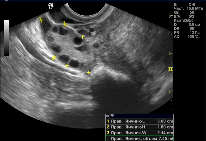 Киста яичников на УЗИ