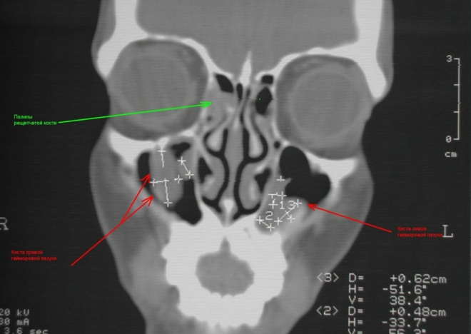 киста в гайморовой пазухе фото