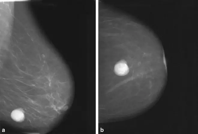 Новообразование в молочной железе