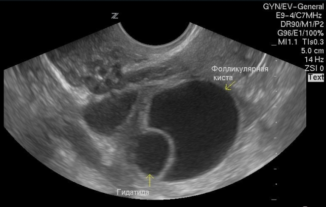 Фолликулярная киста яичника на УЗИ