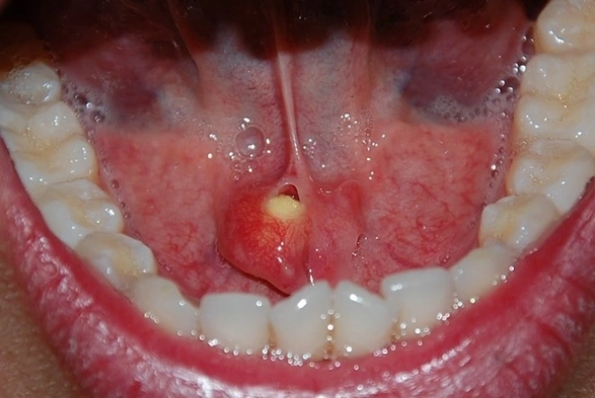 Кистозное образование во рту