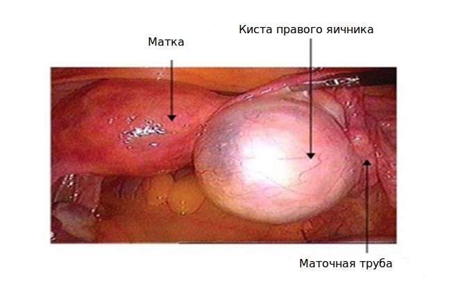 Фолликулярная киста правого яичника