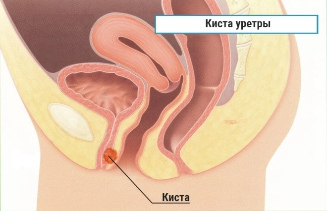 Как выглядит киста уретры у женщин