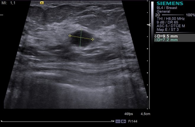 Киста молочной железы на УЗИ
