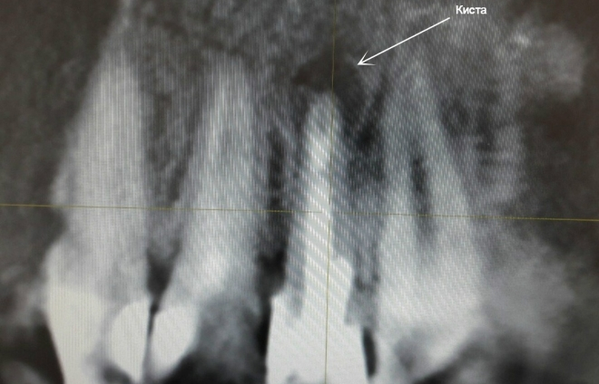 радикулярная киста верхней челюсти на рентгене