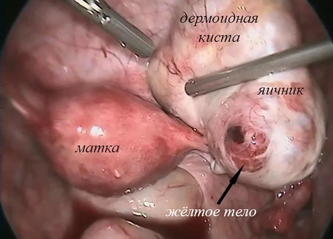 Киста яичника через камеру хирурга