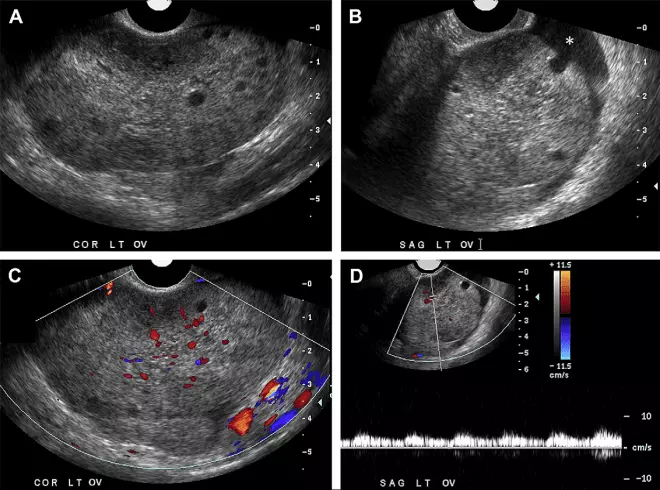 Кисты яичников разных типов на УЗИ
