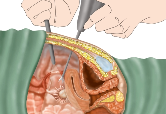 Лапароскопия при поликистозе яичников на схеме