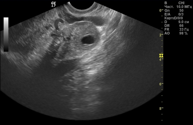 лютеиновая киста яичника на УЗИ