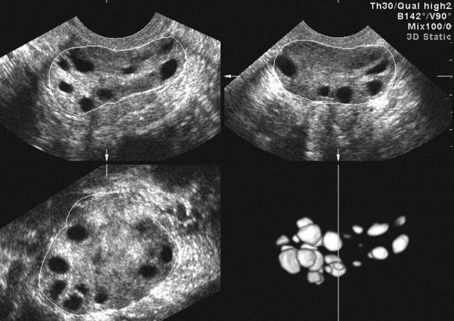 Поликистоз яичников на УЗИ