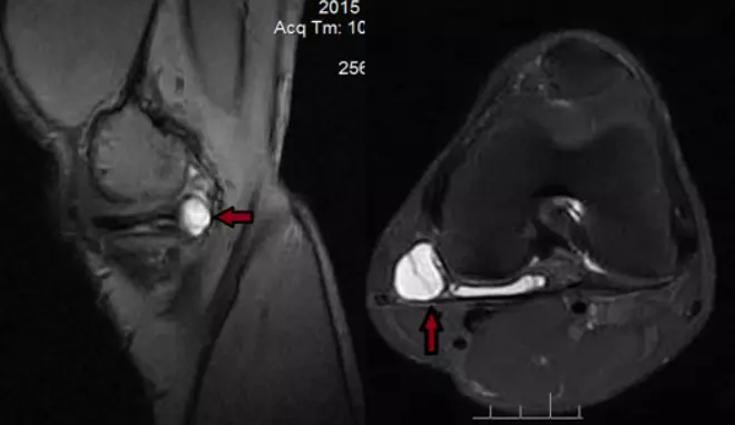 МРТ колена с кистой мениска