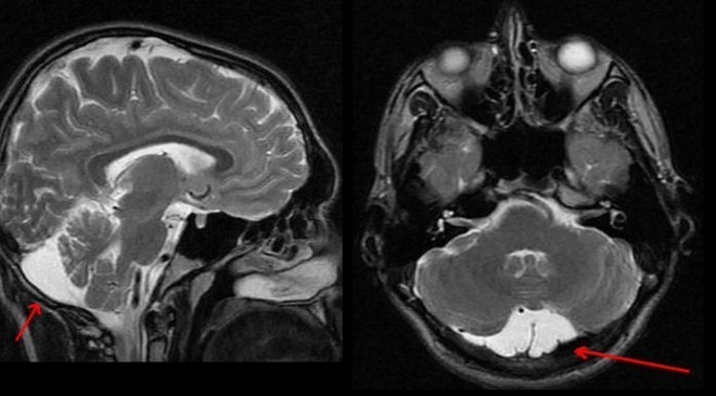 ретроцеребеллярная киста головного мозга
