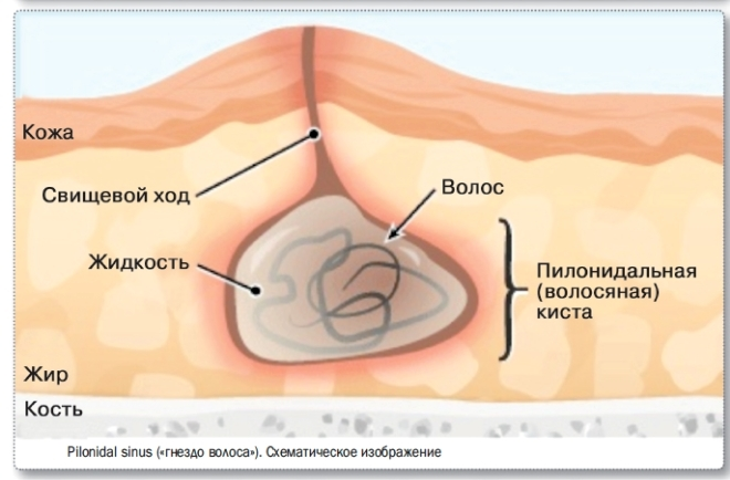 Как формируется киста копчиковая